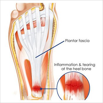 Evaluation of Plantar Fasciitis Treatments - Sydney Heel Pain Clinic