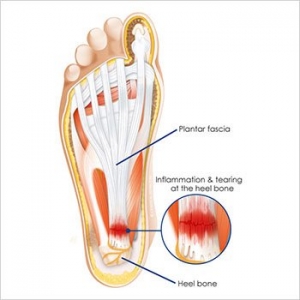 pain in heel of foot when walking