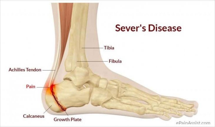 A Boy with Heel Pain After Walking to 