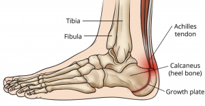 Pain In The Back Of The Heel Causes And Treatment
