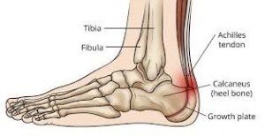 Upper Heel Pain