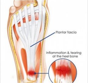 Pain in the Bottom of My Heel