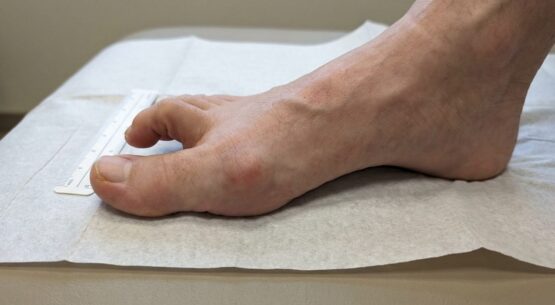 Bunion Hammertoes bunion hammertoes