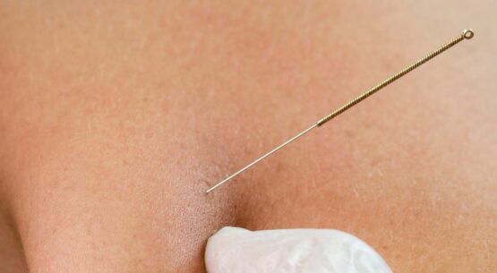 Heel Pain Specialist | Expert Podiatrist and Heel Pain Treatment Manual Therapy & Dry Needling