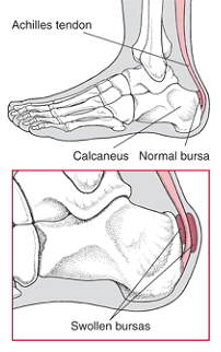 Bursitis-in-the-Heel bursitis in the heel