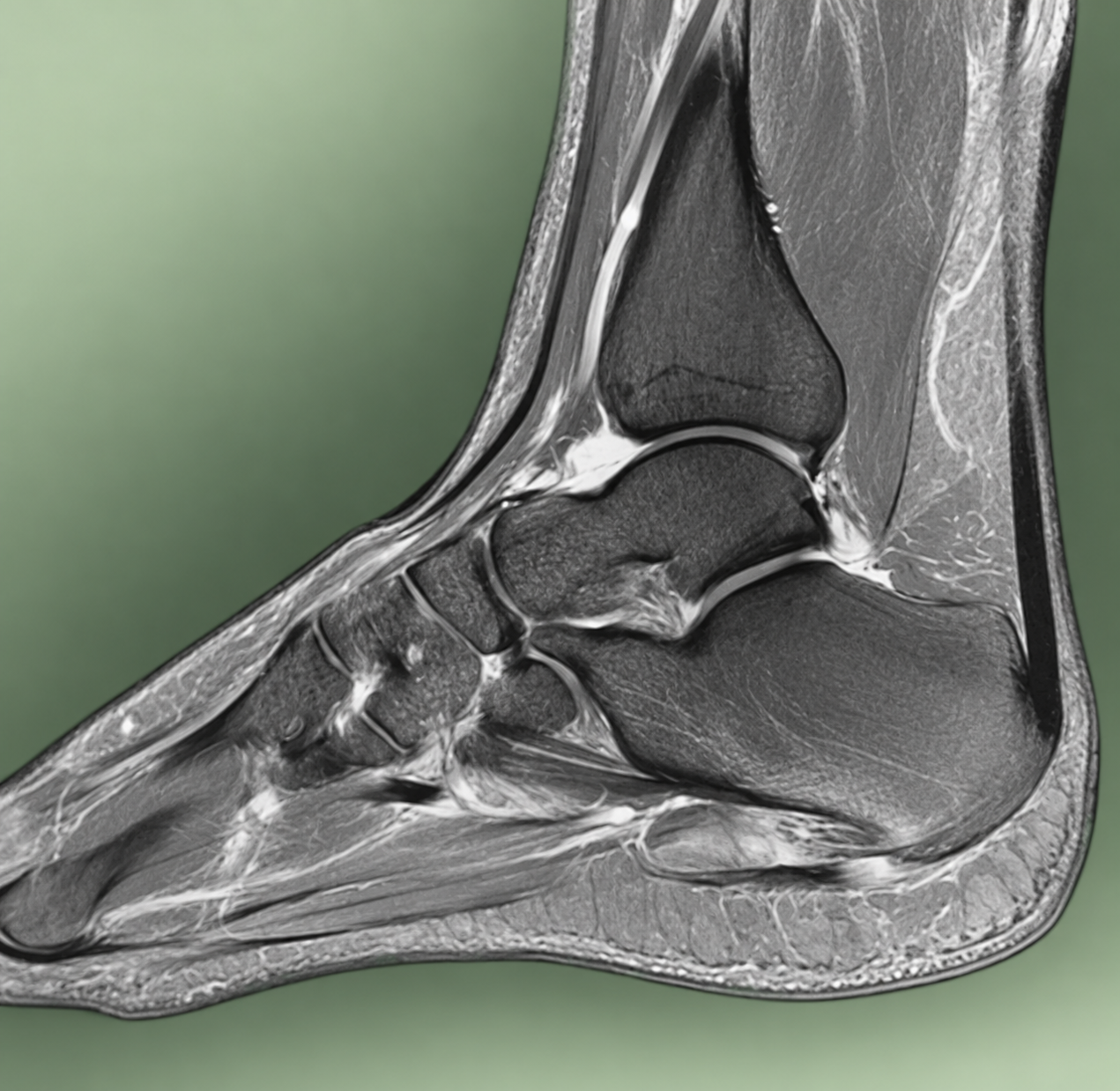 MRI imaging of the plantar fascia, heel bone and surrounding soft tissues