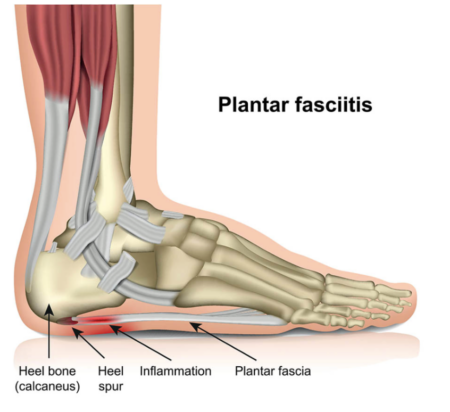 Plantar fasciitis is a painful inflammatory condition