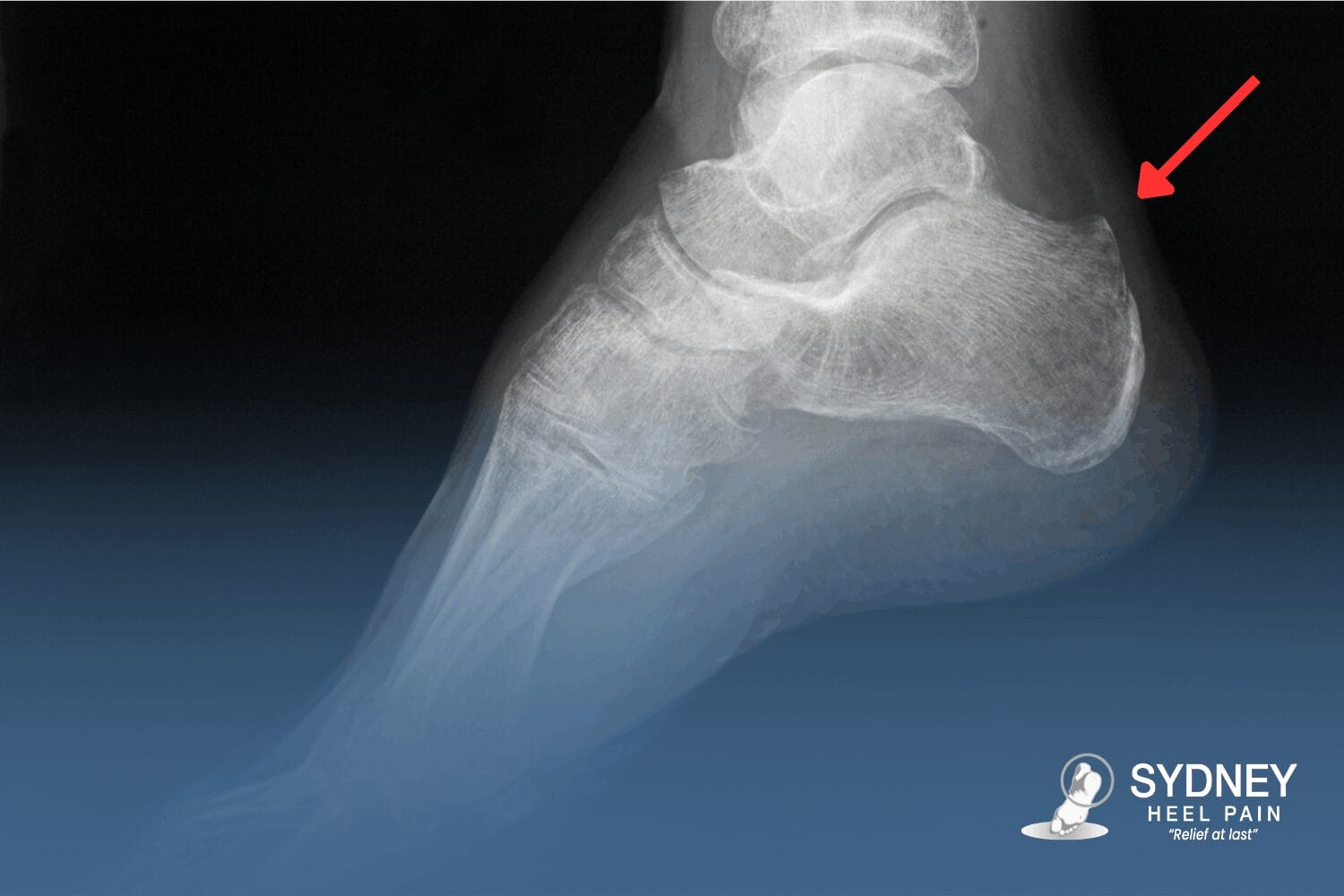 shoes for achilles tendonitis Shoes for Achilles Tendonitis